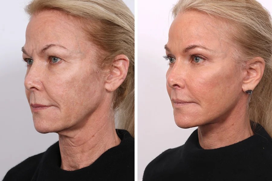Endoscopic facelift​