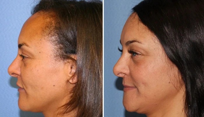 Hairline lowering results in dubai