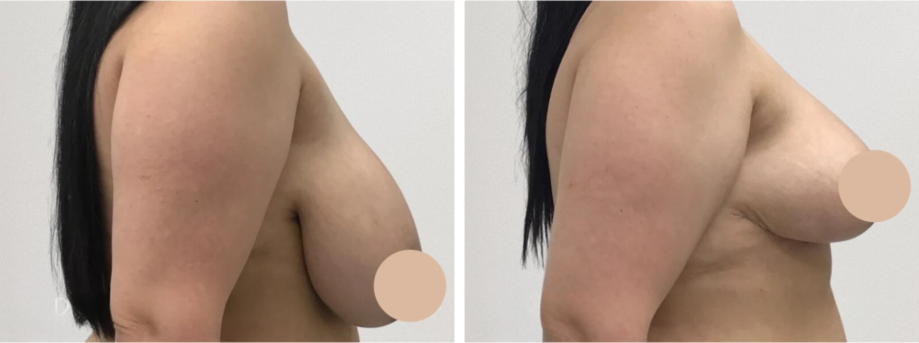 Breast reduction pictures before after