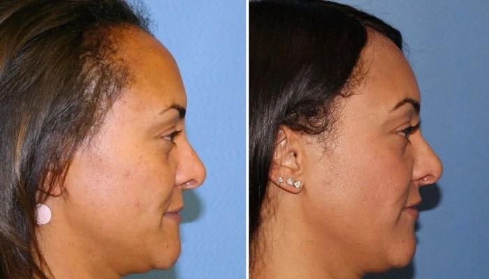 Hairline lowering abu dhabi