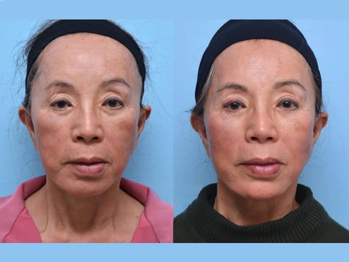 Mesotherapy in dubai