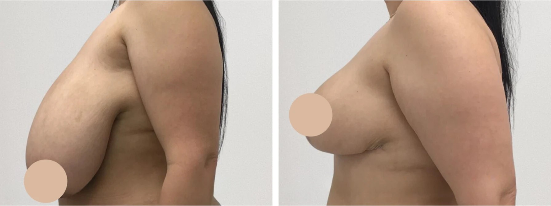 Breast reduction at perfect drs