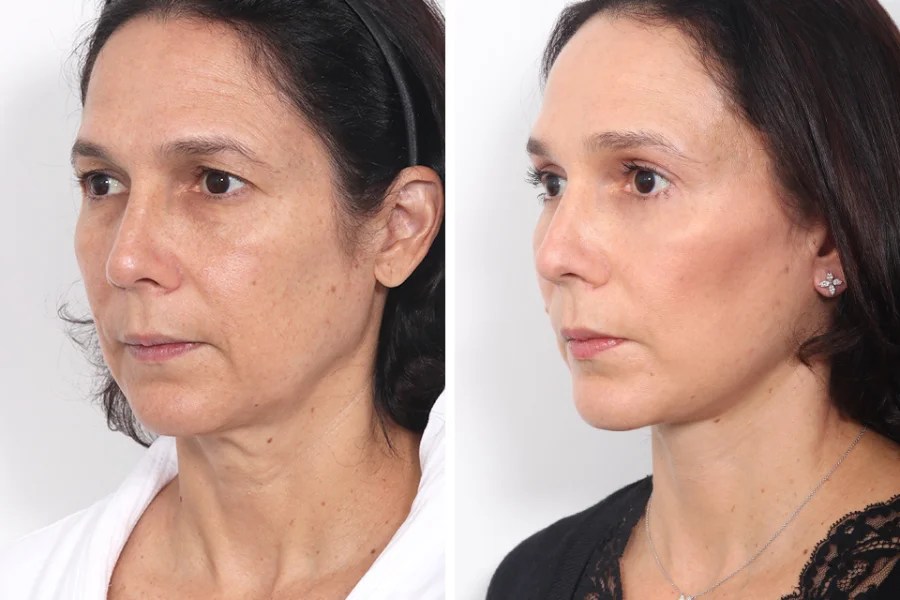 Endoscopic facelift before after in abu dhabi