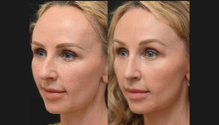 Hairline lowering pictures in dubai