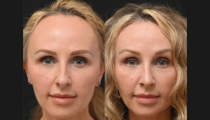 Hairline lowering before after abu dhabi