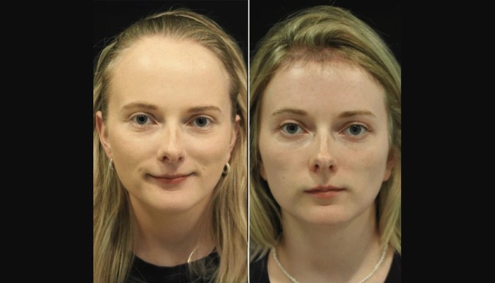 Hairline lowering in uae