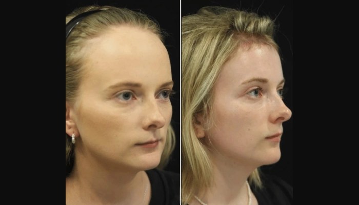Hairline lowering results before after