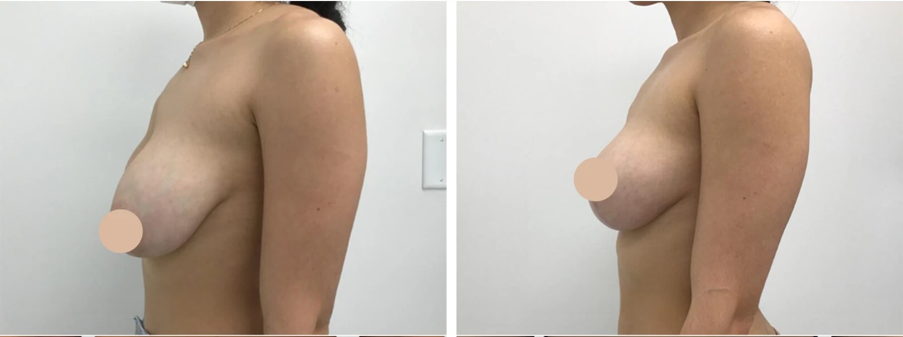 Breast reduction before and after in UAE