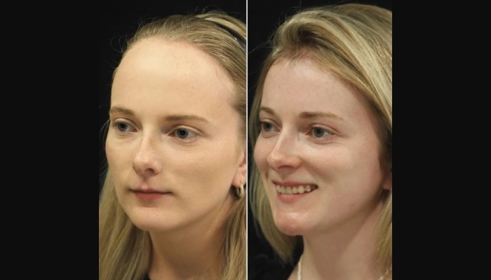 Hairline lowering before after dubai