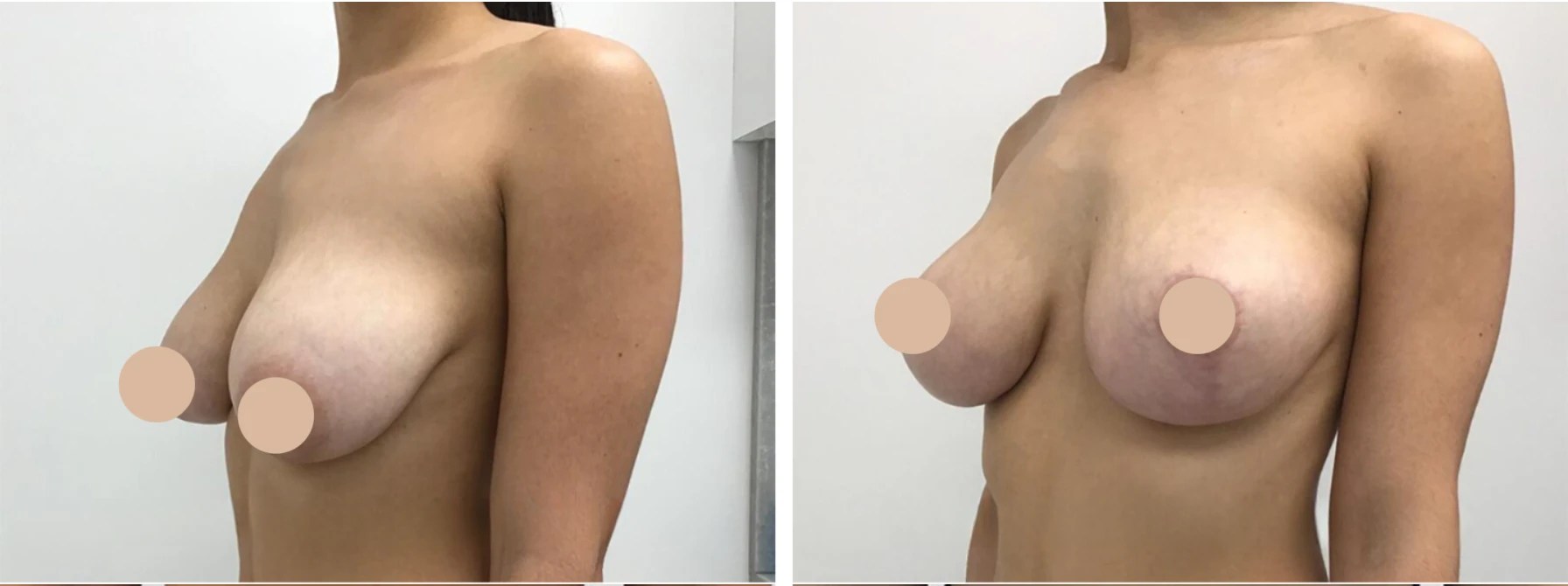 Breast reduction before after in dubai