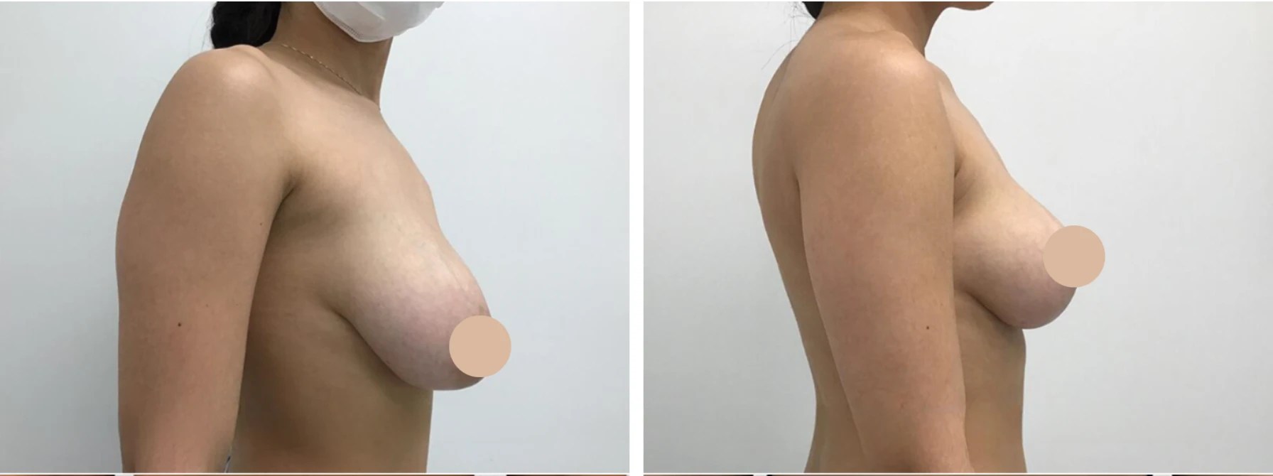 Breast reduction before after in abu dhabi