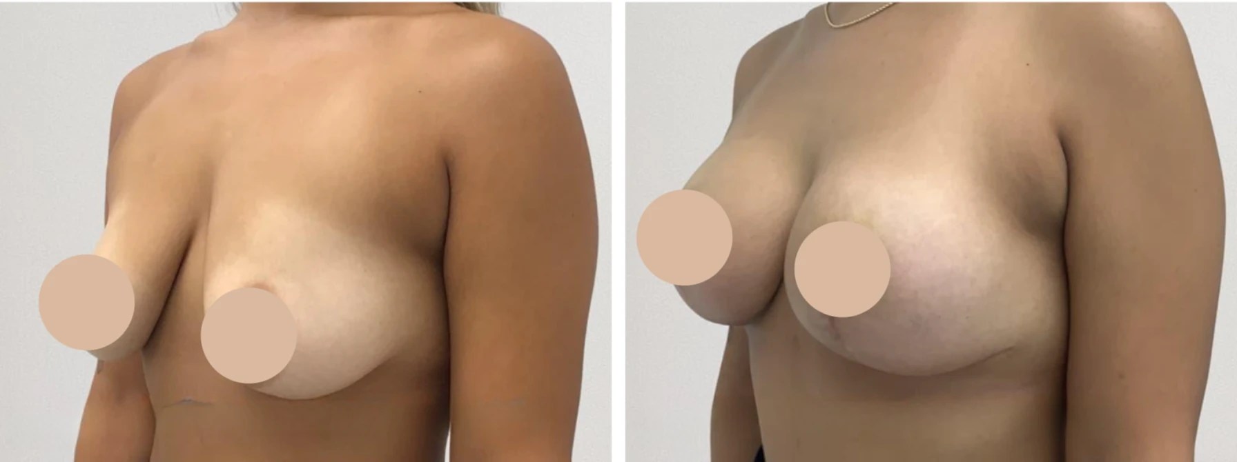 Breasr lift before after