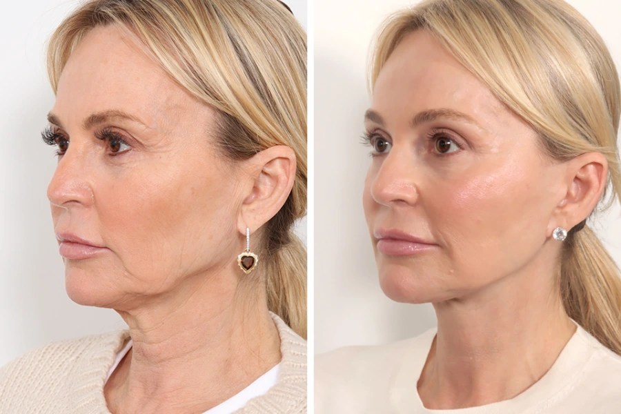 Endoscopic facelift before after