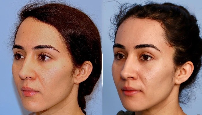 Forehead reduction pictures before after