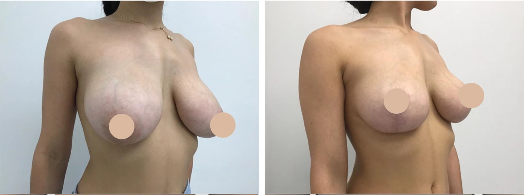 Breast reduction in abu dhabi