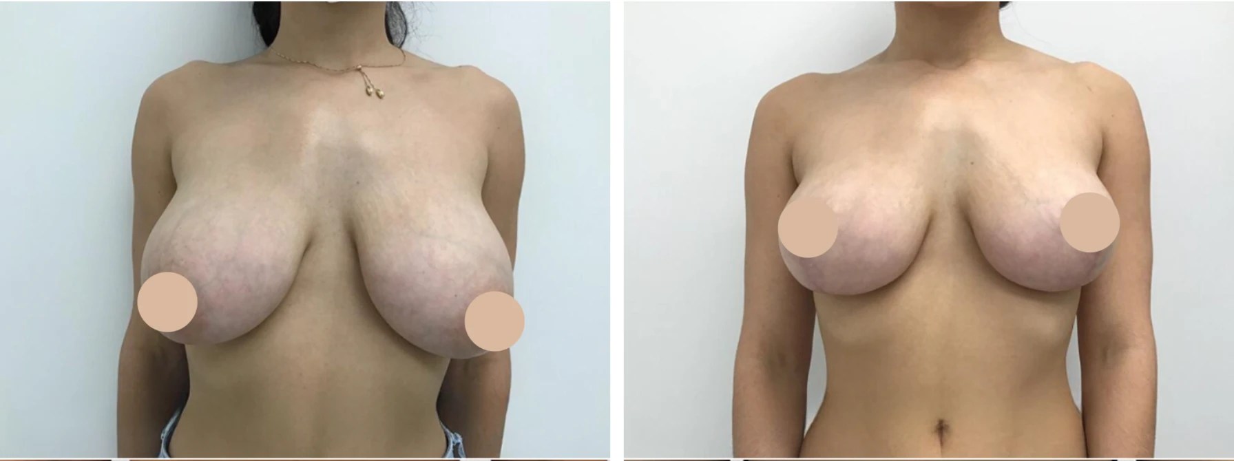 Breast reduction before after in uae