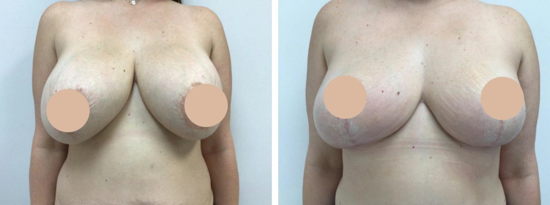 Mastopexy results in uae