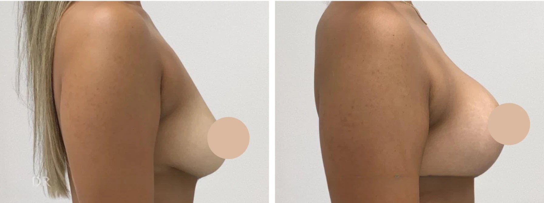 Breast reduction in abu dhabi