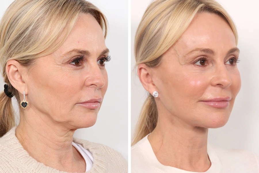 Endoscopic brow lift in dubai