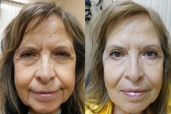 Botox For Blepharospasm in dubai
