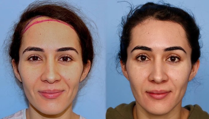 Forehead reduction pictures before after