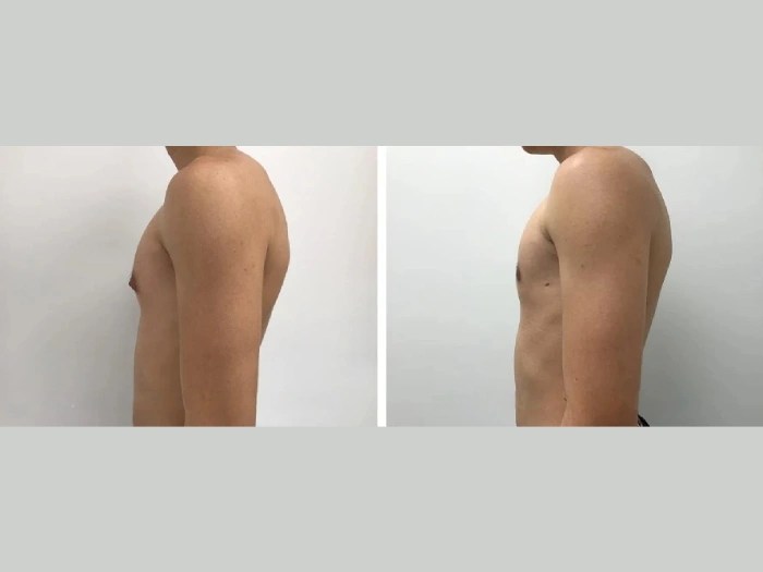 Gynecomastia pictures in dubai