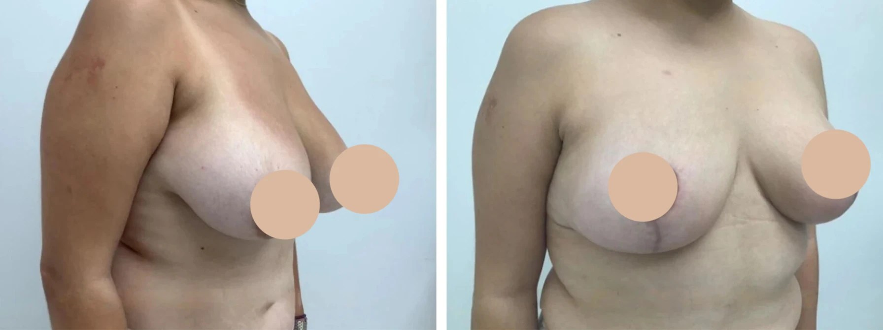 Breast reduction surgery in abu dhabi