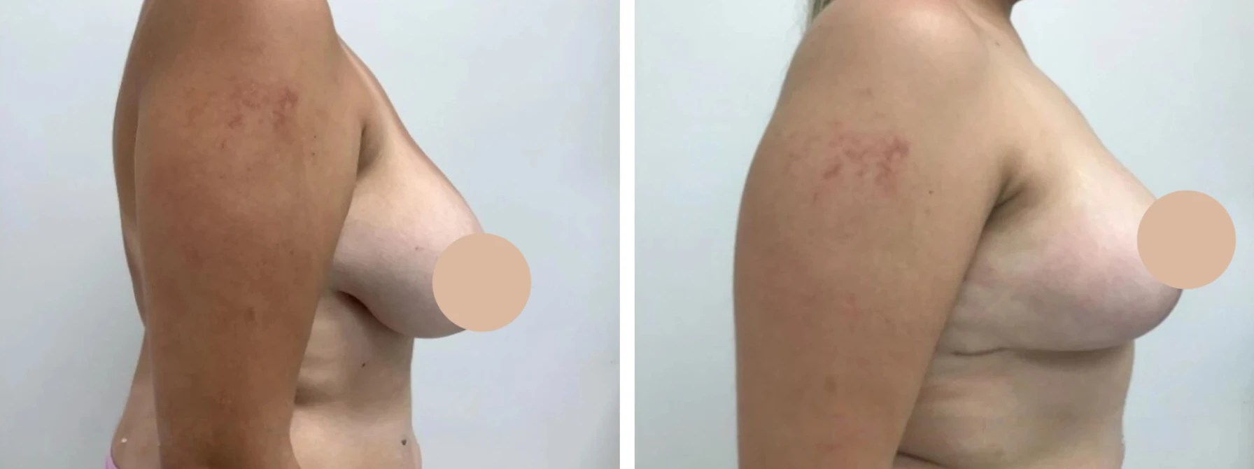 Breast reduction pictures before after