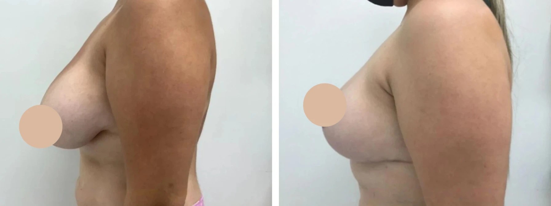 Breast reduction before after in abu dhabi