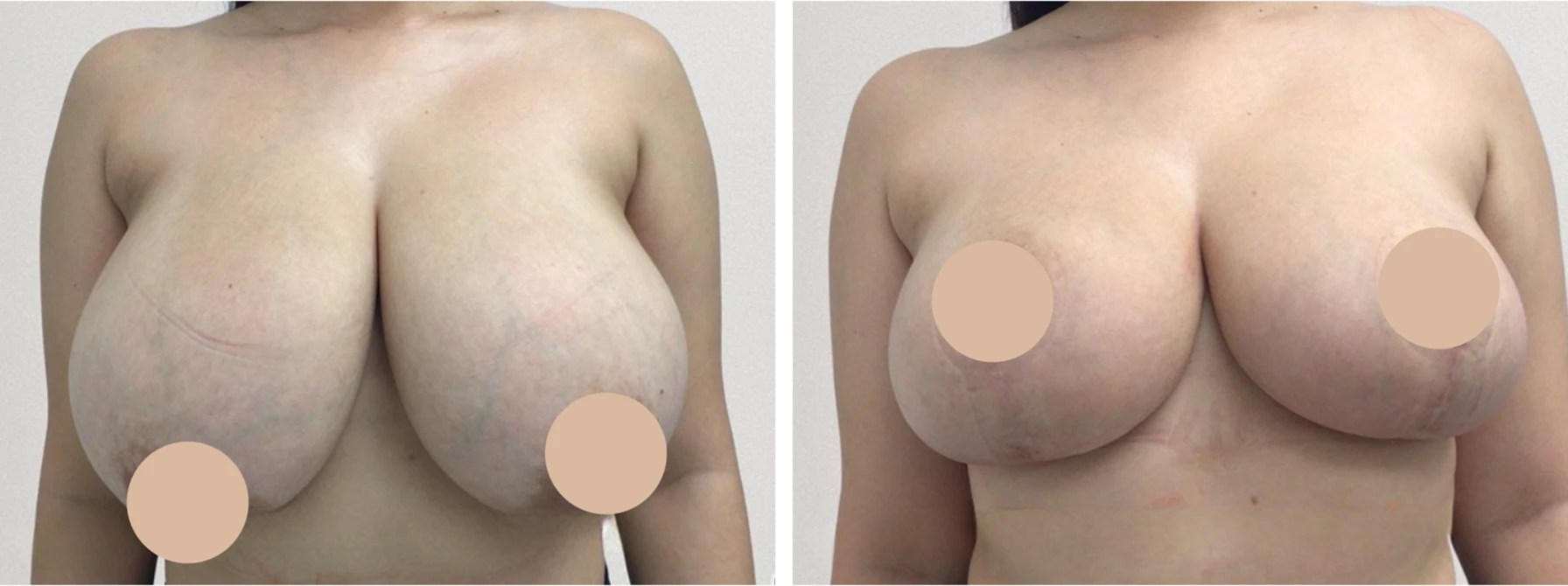 Breast reduction before after in uae