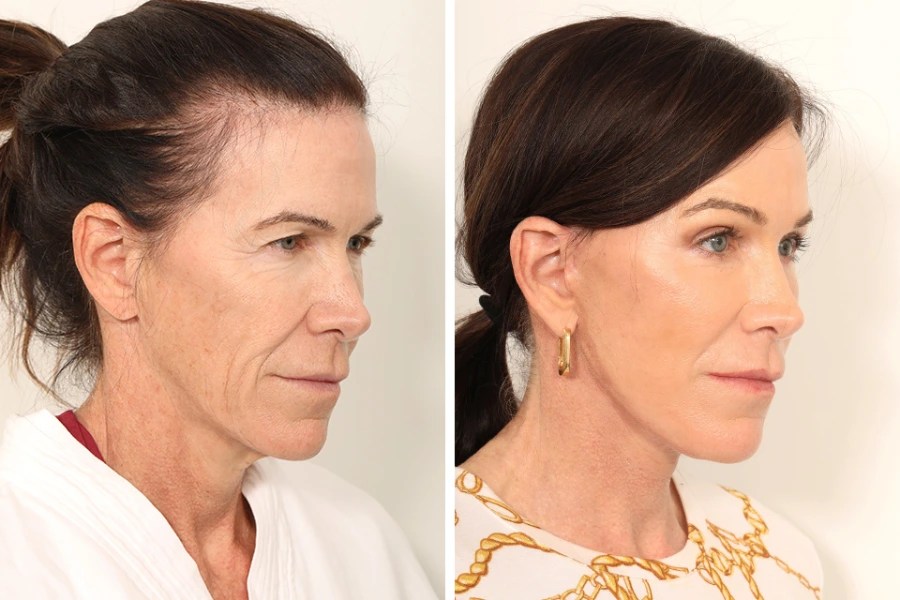 Endoscopic facelift before after in abu dhabi
