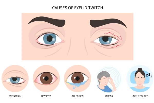 Botox For Blepharospasm before after