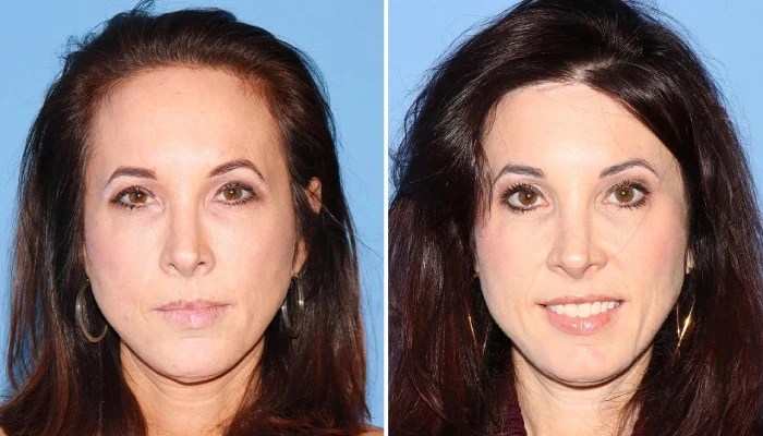 Forehead reduction before and after in abu dhabi