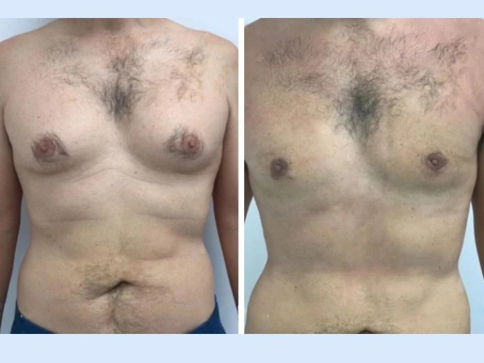 Gynecomastia before after images