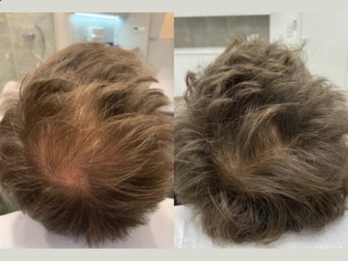 Mesotherapy before after