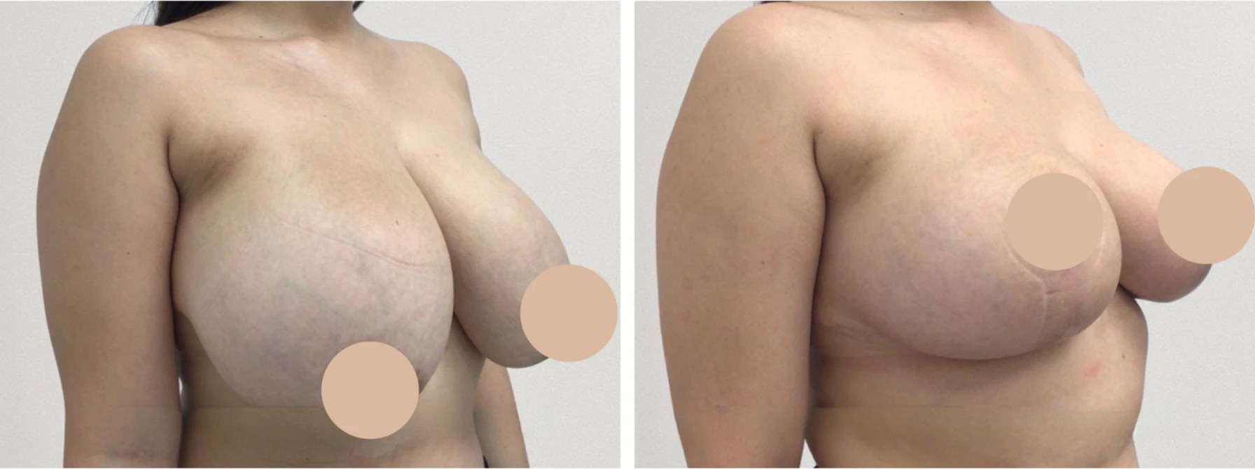 Breast reduction pictures in dubai