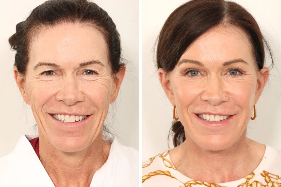 Endoscopic facelift before after in dubai