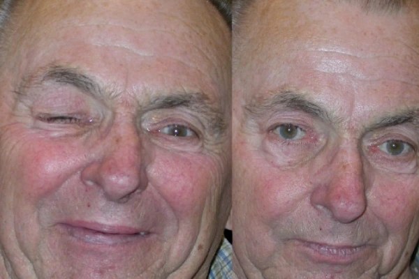 Botox For Blepharospasm pictures before after