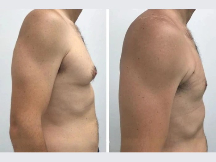 Gynecomastia images in dubai