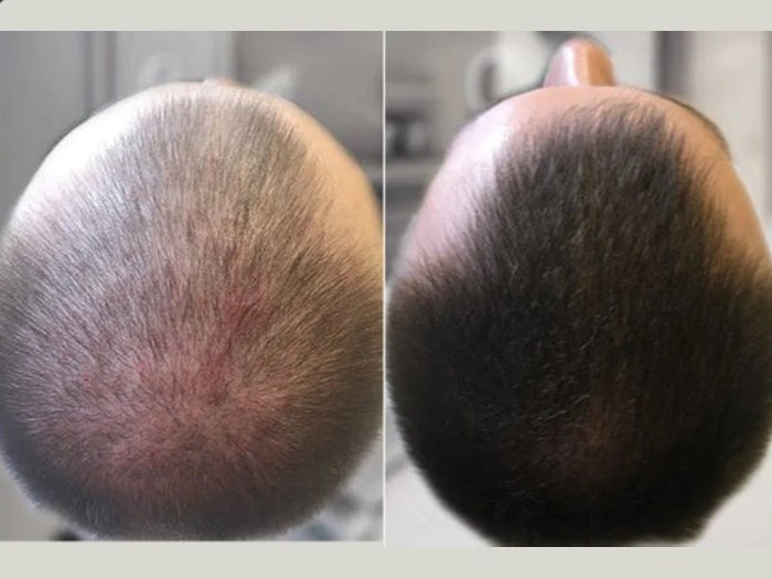 Mesotherapy before after pictures