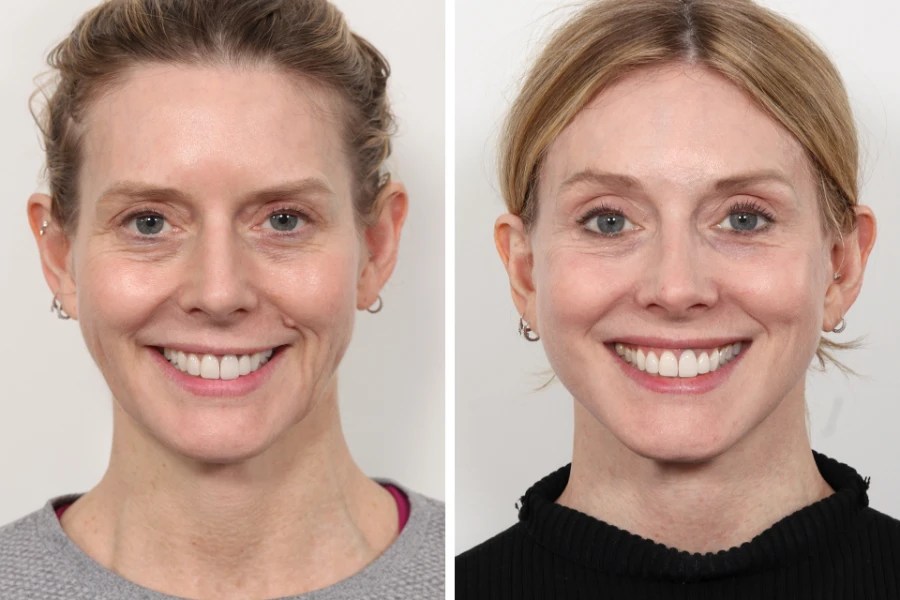 Endoscopic forehead lift in abu dhabi
