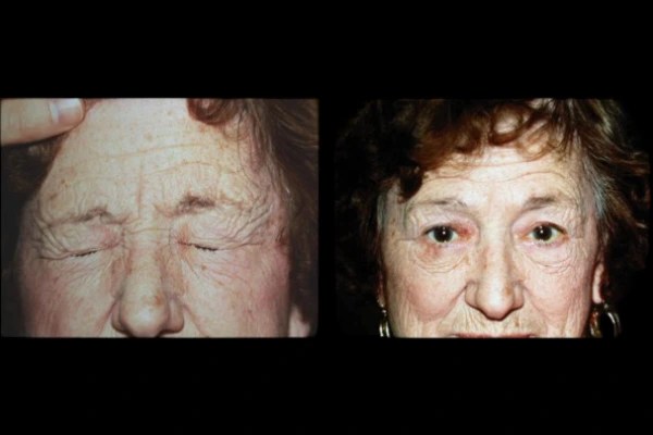 Botox For Blepharospasm before after