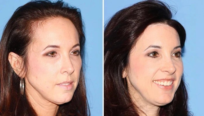 Forehead reduction before and after in dubai