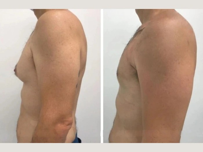 Gynecomastia before after