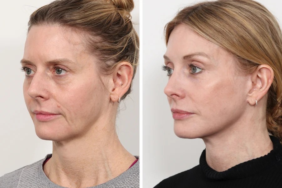 Endoscopic forehead lift in dubai