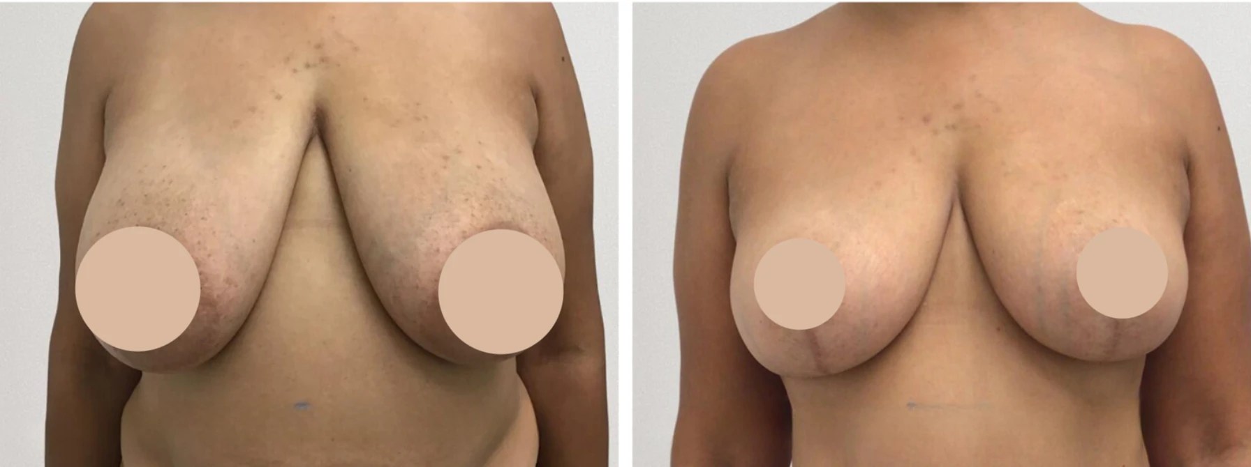 Breast reduction For women in dubai