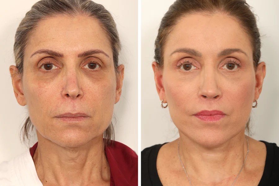 Endoscopic facelift before after in dubai