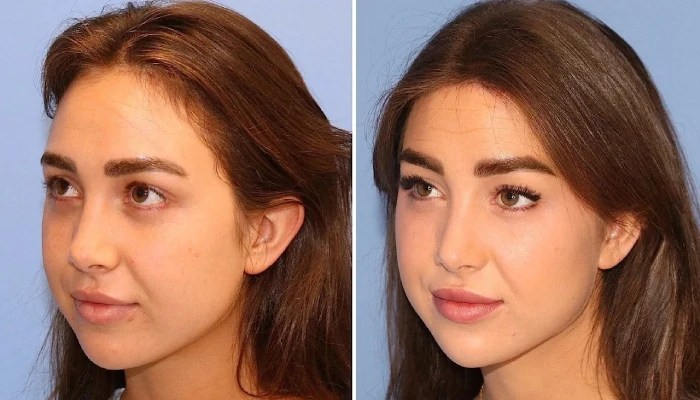Hairline lowering before after