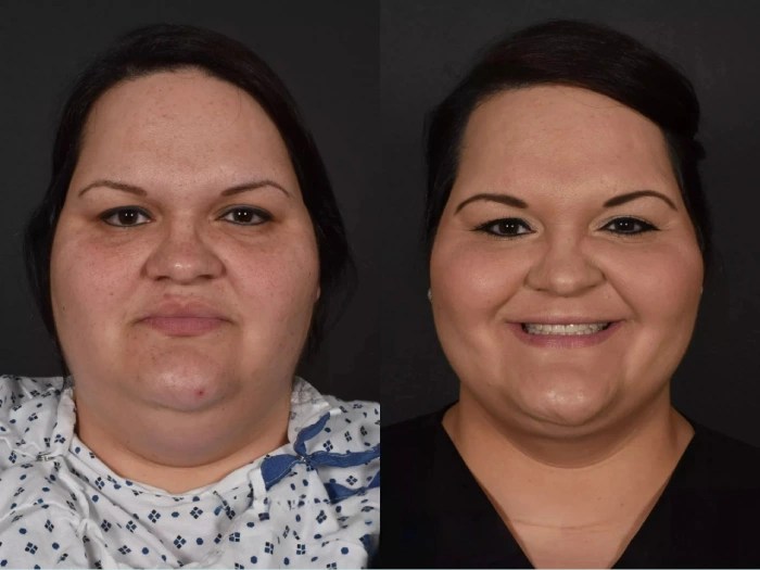 Mesotherapy before after dubai