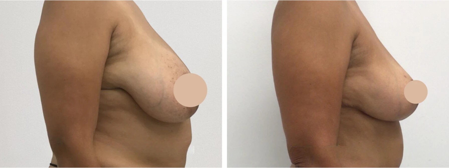 Breast reduction before after in uae